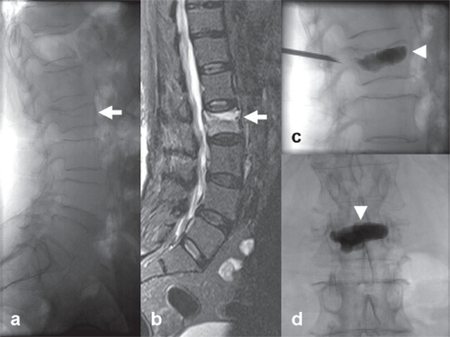 Figure 7 Example of percutaneous vertebroplasty for lumbar osteoporotic fracture. A 72-year-old female patient with severe back pain. (a) Lateral lumbar X-ray demonstrates a fractured L2 vertebral body (white arrow) (b) High signal on STIR MR sequence due to bone edema, compatible with a recently onset osteoporotic fracture (white arrow) (c–d) Percutaneous unipedicular vertebroplasty and cement stabilization of the affected body (Optimed Vertebroplasty System, Pyramed, Esher, United Kingdom). A bone biopsy specimen was taken before cement injection (white arrowheads) to exclude any underlying malignancy. The patient experienced immediate post-operative pain relief and was ambulated the following day.