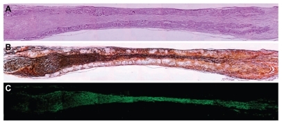 Figure 13 Longitudinal sections of nerve regenerated within the implanted guide channel. In the conduit, the regenerated nerve bridged the 10 mm gap, reconnecting the two sciatic nerve stumps. (A) Four months after surgery, hematoxilyn and eosin staining shows the presence of regenerated tissue filling the conduit lumen; decreased lumen diameter is observable at middle length of the guidance channel. Regenerated tissue positive to Bielschowsky staining (B) and to anti-β-tubulin antibody (C) shows nervous projections oriented along the major axis of the prosthesis bridging the 10 mm gap between the severed sciatic nerve stumps (image sequence collected at 4 × magnification).