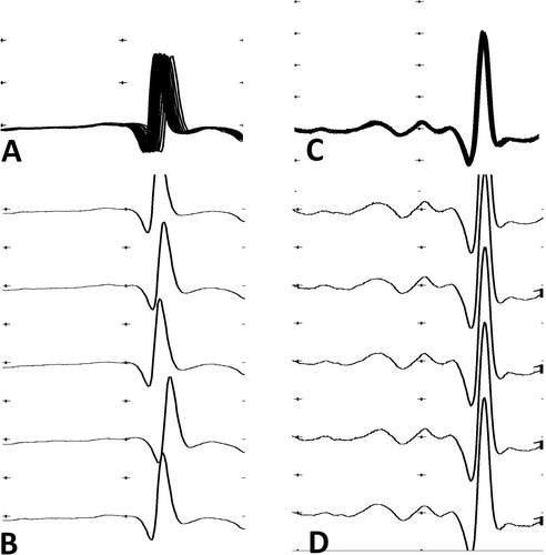 Figure 2. Stimulated single-fibre electromyography recordings of the orbicularis oculi muscle of a patient with H. hypnale envenoming. (a) superimposed and (b) non-superimposed recordings of a fibre with a MCD of 56.01 μs in a patient who had a mean jitter of 41.04 μs, recorded 29 hours after the bite. (c) Superimposed and (d) non-superimposed recordings of a fibre with a MCD of 6.36 μs in the same patient who had a mean jitter of 15.12 μs, recorded six weeks after the bite.