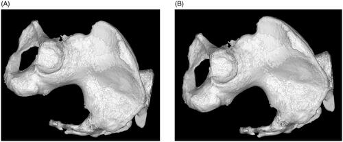 Figure 2. 3D computed tomography. (A) APP is flat in a neutral position (parallel to CT scan table). (B) APP is 15° anteverted compared with CT scan table.