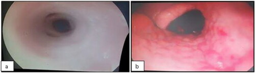 Figure 1. The respiratory tract irritation score: score 1 - smooth and shiny pink mucous membranes without secretions in nasopharynx or trachea (a); score 2 - reddish mucosa, evidenced vessels, and irregularities in nasopharynx (b).