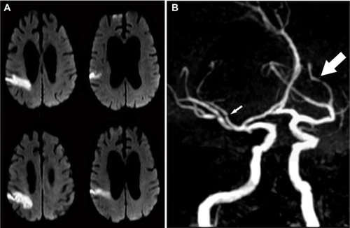 Figure 2 Stroke and intracranial atherosclerosis.