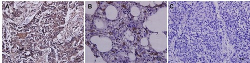 Figure 2 Immunohistochemical detection of PDPN in SqNSCLC patient samples: (A) PDPN-positive SqNSCLC section; (B) section displaying PDPN-negative staining in adjacent normal lung tissue and some positive staining in endothelial cells of lymphatic vessels; (C) PDPN-negative SqNSCLC section (×400, bar=5 µm).Abbreviations: PDPN, podoplanin; SqNSCLC, squamous non-small cell lung cancer.