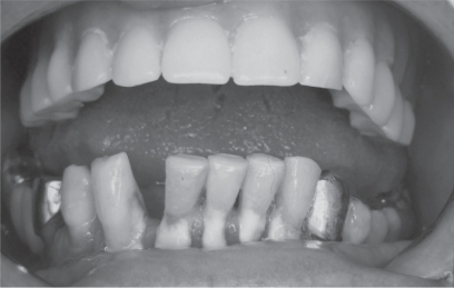 Figure 4 Visible calculus on the labial surfaces of the lower teeth of an older female, due to poor oral hygiene.