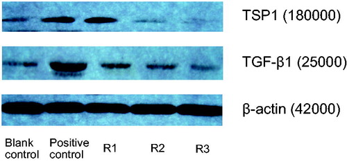 Figure 4. Effects of triptolide on expression of TSP1 and TGF-β protein in AngII-induced HK-2 cells. Note: Blank control (no any drugs were added); positive control (10−7 mol/L AngII only); R1: triptolide 0.1 µg/L + 10−7 mol/L AngII; R2: triptolide 1 µg/L + 10−7 mol/L AngII; R3: triptolide 10 µg/L + 10−7 mol/L AngII.