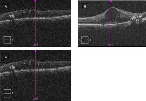 Figure 1 Morphological calcification of optical coherence tomography (OCT) patterns in diabetic macular edema demonstrating (A) sponge-like diffuse retinal thickness (SLDRT), (B) cystoid macular edema (CME), and (C) subretinal fluid (SRF).