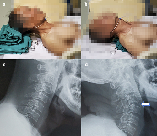 Figure 1 A typical case, a 69-year-old male, had quadriplegia caused by fall and underwent imaging examination 12 hours after injury. (a) The flexion posture of the cervical vertebra depends on raising the head about 15cm. (b) The shoulder is raised about 10cm, and the cervical vertebra is in a hyperextension position. (c) There was no obvious instability in the state of cervical flexion. (d) When the cervical vertebra was overextension, the C3/ 4 was obviously unstable (white arrow).