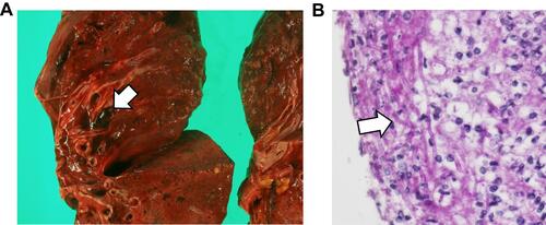 Figure 5 (A) The right pulmonary artery contained an embolus (arrow). (B) Filamentous fungi (arrow) were detected in the embolus by Periodic acid-Schiff staining (×400).