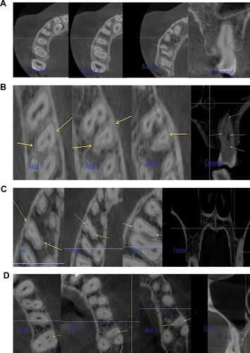 Figure 3 Radiographic representation of canal types I, II, IV, and V in axial and coronal sections on CBCT images (arrows representing position of mesiobuccal canals in MFMs) (Axial 1: Coronal part of the mesiobuccal root in axial section. Axial 2: Middle part of the mesiobuccal root in axial section. Axial 3: Apical part of the mesiobuccal root in axial section). Coronal: coronal section. (A) Type I in axial and coronal sections. (B) Type II in axial and coronal sections. (C) Type IV in axial and coronal sections. (D) Type V in axial and coronal sections.