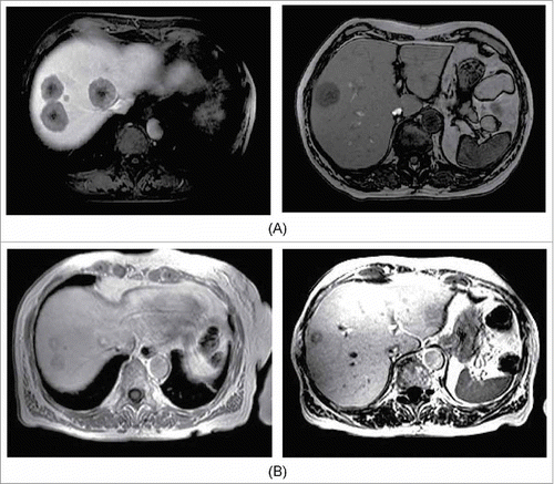 Figure 2. Radiological assessment before (A) and after (B) 4 cycles of chemotherapy with FOLFOX and panitumumab. A: Basal CT scan, October 23, 2015. B: CT scan, December 17, 2015.