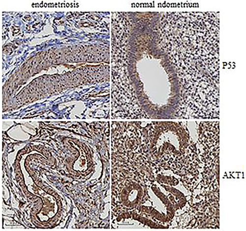 Figure 10 Expression of P53 and AKT1 in normal endometrium and endometriosis.