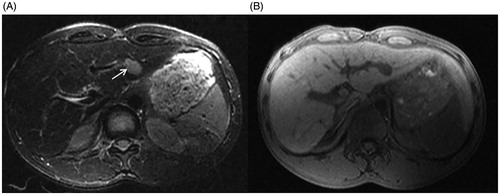 Figure 2. A 35-year-old man presented with recurrent hepatocellular carcinoma after radiofrequency ablation. (A) A nodule is seen in the left lateral lobe of the liver. The fsFRFSE T2WI sequence shows a hyperintense lesion (arrow). (B) The 3 D Dyn T1WI sequence shows a hypointense lesion.