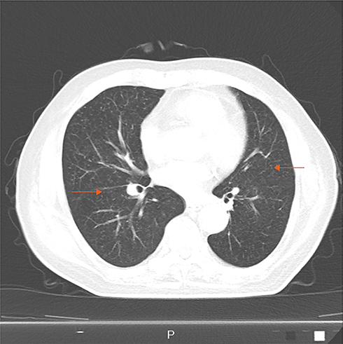 Figure 4 Chest CT showing: partially absorption of the miliary foci, suggesting that anti-tuberculosis treatment is effective.