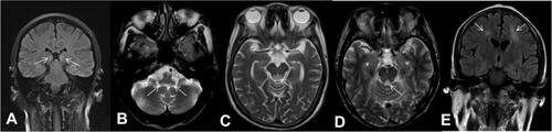 Figure 1 (A) A 38-year-old woman (Patient 1) had a history of acute pancreatitis and presented with the classic triad. FLAIR coronal imaging showed hyperintensity of the symmetric medial thalamus. The white arrows represent the symmetric medial thalamus. (B) A 57-year-old man (Patient 7) had pyloric obstruction and presented with the classic triad. T2WI axial imaging showed hyperintensity of the medial vestibular nuclei. (C) A 68-year-old woman (Patient 4) had a history of surgery and fasting for her gastric cancer and presented with delirium and persecutory delusion. T2WI axial imaging showed hyperintensity of the tectal plate. (D) A 71-year-old man (Patient 8) had a history of colon cancer and presented with the classic triad. T2WI axial imaging showed hyperintensity of the periaqueductal region. (E) A 42-year-old woman (Patient 2) had a history of acute pancreatitis and presented with drowsiness and oculomotor abnormalities. FLAIR coronal imaging showed hyperintensity of the symmetric subcortical white matter. The white arrows represent the symmetric subcortical white matter.Abbreviations: FLAIR, fluid-attenuated inversion recovery; T2WI, T2-weighted imaging.