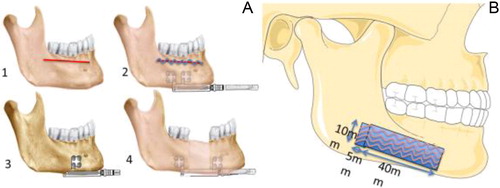 Figure 1. A: scheme of the mandible distraction osteogenesis surgical procedure. B: scheme of the harvested samples of periosteum.