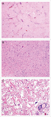 Figure 1. Examples of treatment effect following radiotherapy of undifferentiated pleomorphic sarcoma. Representative photographs of H+E stained undifferentiated pleomorphic sarcoma of the extremity and trunk demonstrating increased tumor necrosis and hyalinization following radiotherapy. (A) Tumor with extensive hyalinization (H&E, 100x). (B) Tumor with extensive necrosis with ghost and degenerative tumor cells (H&E, 100x). (C) Tumors could also have a mix of both necrosis and hyalinization (H&E, 100x). Cytological changes consistent with treatment effect (inset, H&E, 200x) was also present in this sample.