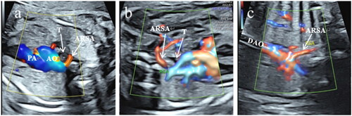 Figure 1. Color Doppler ultrasound images of fetal aberrant right subclavian artery (ARSA). (a) In the three-vessel and tracheal view, ARSA was detected as an additional vessel arising from the junction of the aortic arch and ductus arteriosus, and color Doppler showed a "C-shaped” vascular ring. (b) In the bilateral subclavian artery sections, the right subclavian artery travels straight and lies posterior to the trachea during ARSA. (c) Coronal view of the aortic arch showing the right subclavian artery originating from the beginning of the descending aorta and proceeding toward the right shoulder. PA: pulmonary artery, AO: aorta, T: trachea, DAO: descending aorta.