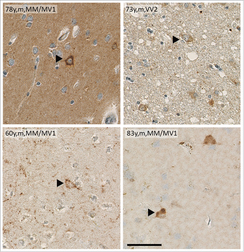 FIGURE 2. Brain samples of sCJD patients show intracellular deposits of PrPSc. Immunohistochemistry of human cortical brain samples of sCJD showing intracellular PrPSc deposition similar to that seen in Tg(PrPΔ214-229). Age, gender and sCJD type are indicated in the picture. Scale bar is 100 μm.