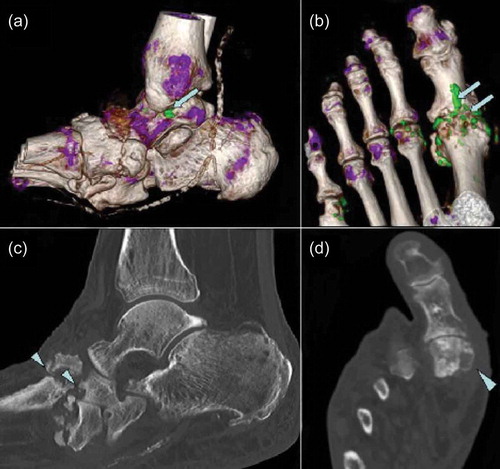 Figure 3. Dual-energy computed tomography (DECT) images of ankle and foot (a, b) showing MSU crystal deposition in green color (arrows) and corresponding CT images (c, d) showing erosions (arrowheads). Reproduced with permission from Chowalloor PV, et al: Ther Adv Musculoskelet Dis 2014;6(4):131-43. [Citation40].