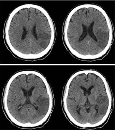 Figure 1 Brain computed tomography showed acute ischemic infarcts over the left posterior parietal lobe in the left middle cerebral artery territory without causing ventricular effacement or cerebral midline shift.