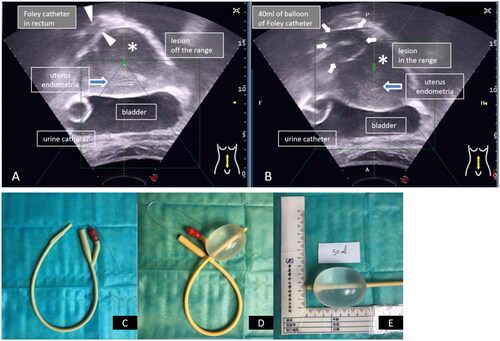 Figure 1. (A) The intrarectal Foley catheter was in the rectum without degassed water injection. The lesion was off range, which was infeasible for HIFU. (B) The degassed water balloon of the intrarectal Foley catheter moved the uterus forward, and the lesion was in range. (C) The Foley catheter used in the present study (Weili Medical Device Co., LTD, Guangzhou, China). (D) The end balloon was filled with degassed water. This was used to fix the catheter in the bladder. (E) The size of the degassed water balloon was 60 mm × 45 mm, which could move the uterus 22.5 mm forward to the abdominal wall. *The green square in A and B is the range square of the HIFU treatment range.