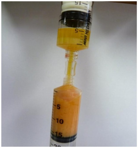 Figure 15 Anaerobic transfer from disposable processing syringe (above) to adipose fat graft syringe (below).