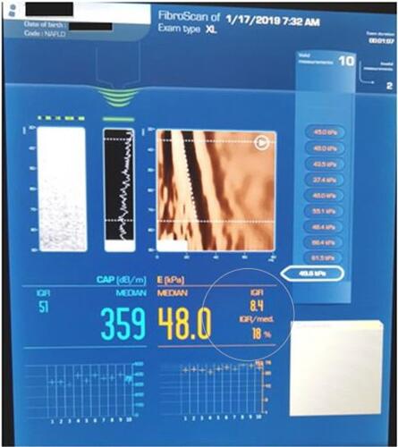 Figure 2 Vibration-controlled transient elastography (VCTE) and controlled attenuation parameter (CAP) from the Fibroscan® device.