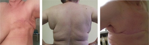 Figure 3 Lymphedema on the operated chest wall in three patients (front view, 3 months after the surgery; back view, 9 months after the surgery; and side view, 6 months after the surgery).