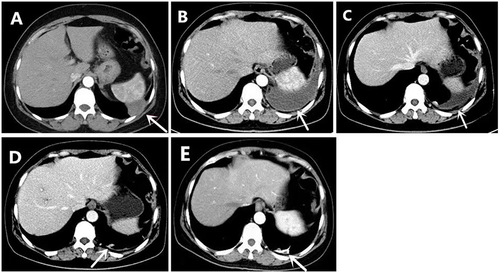 Figure 1 Computed tomography (CT) of chest in different treatment phases. Lung and left pleura metastasis were found one year after radical surgery (A). Pleural effusion was appeared after combined therapy of gemcitabine and carboplatin and sintilimab (B). After paclitaxel albumin and doxorubicin hydrochloride liposome and sintilimab combined treatment for two and six months, pleural effusion was stable (C and D). Continued paclitaxel albumin and sintilimab combined treatment for another fifteen months, lesions were controlled well (E).