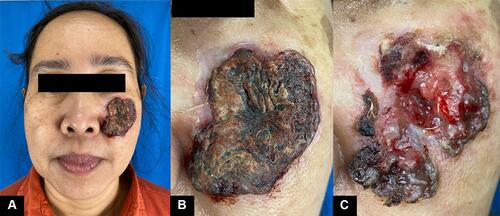 Figure 1 The lesion covered with a thick crust (A and B) and ulcer revealed within by removing the crust (C).