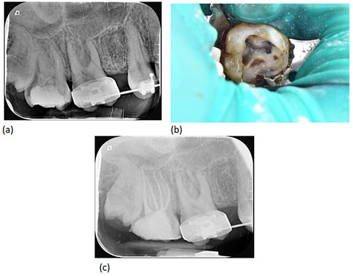 Figure 1 Clinical and radio-graphical presentation of tooth #17. (a) Pre-operative periapical radiograph showing widening of the apical lamina dura associated with the palatal root for tooth #17. (b) Access cavity of tooth #17 under rubber dam isolation, revealing 2 buccal and 2 palatal canal orifices. (c) Post-operative periapical radiograph revealing complete obturation of all canals (mesio-buccal, disto-buccal, mesio-palatal, and disto-palatal canals).