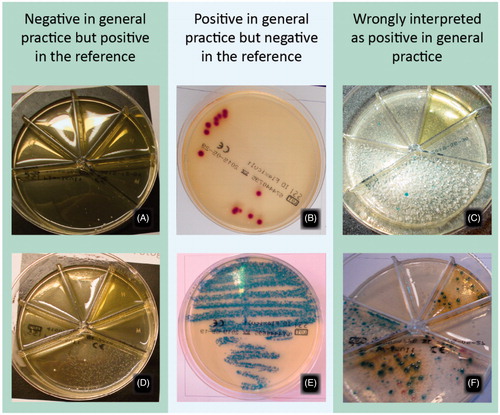 Figure 2. Examples of cultures diagnosed incorrectly in general practice according to the reference standard. A and D: Correctly answered as negative in general practice according to the photograph and as S. saprofyticus 104 CFU/mL and Citrobacter koseri 104 CFU/mL in the microbiological department. B and E: Correctly answered as E. coli 103 CFU/mL and Enterococcus faecalis 105 CFU/mL in general practice but as negative in the microbiological department. C and F: Incorrectly answered as significant growth in general practice, and as negative and mixed flora in the microbiological department.