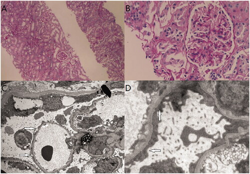 Figure 3. Renal biopsy of case 3. (A) Epithelial cells of renal tubule showed granular and vacuolar degeneration (H&E staining, ×4). (B) Mild proliferation of mesangial cells and stromal cells (H&E staining, ×400). (C & D) electron microscopy image showing minimal change disease, extensive fuzing of podocyte processes of the epithelial cells (arrow).