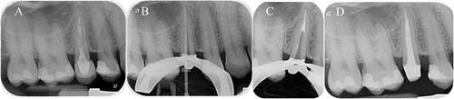 Figure 5 Clinical example of RCRt with fiber post removal.