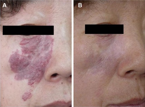 Figure 2 Pre- and posttreatment photos of PWS on the malar region and orbital region, with hyperplastic lesions.