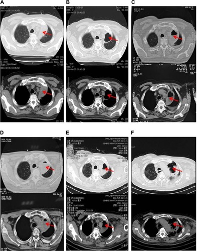 Figure 2 Thoracic computed tomography (CT) showing a mass in the left upper lobe before taking apatinib (A), an obvious cavitation in the mass (B), mass increasing after apatinib suspension for 6 days (C), cavitation extending gradually with added dose of apatinib via monthly CT examination (D and E), and an overall increase of mass despite the larger cavitation (F). The red arrows indicate specific region of tumor.