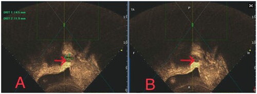 Figure 3. Contrast-enhanced ultrasound obtained from a patient with CP treated with HIFU. (A) Blood supply around the embedding area of the GS in the previous cervical section (red arrow) before HIFU ablation; (B) No blood supply around the embedding area of the GS in the previous cervical (red arrow) after HIFU ablation.