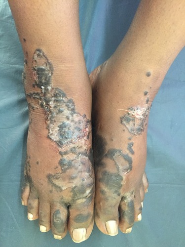 Figure 2 Initial lesions showing well demarcated papules and plaques with dark scales with erosions and edema.