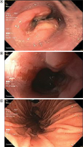 Figure 2. Endoscopy images of esophageal mass.( A) Esophageal mass spanning 8 cm in length from 21 to 29 cm from incisors. ( B) Area of distal esophagus demonstrating Barret’s esophagus. ( C) Normal cardia of stomach.