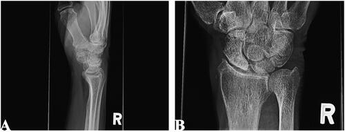Figure 1. Lateral (A) and posteroanterior (B) radiographs of right wrist joint demonstrating proximal pole sclerosis of scaphoid.