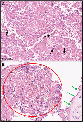 Figure 6 Histopathological biopsy of Loeffler endocarditis. (A) Necrosis and inflammatory damage with eosinophilic infiltration in the first stage (×400), and the black arrow expressing eosinophils infiltration; (B) Thrombosis (red circle) of endocardium (green arrow) in the second stage (×400).