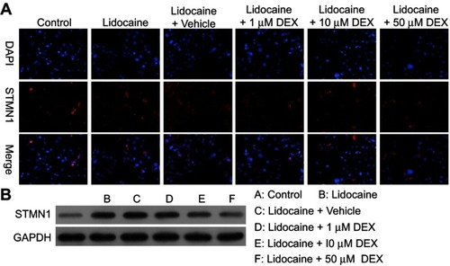 Figure 3 DEX depresses the expression of STMN1 induced by lidocaine in PC12 cells. (A)The expression of STMN1 in lidocaine or lidocaine/DEX combination-treated cells was detected by immunofluorescence staining. (B) The expression of STMN1 in lidocaine or lidocaine/DEX combination-treated cells was analyzed by Western blotting. The experiments were performed in triplicate.