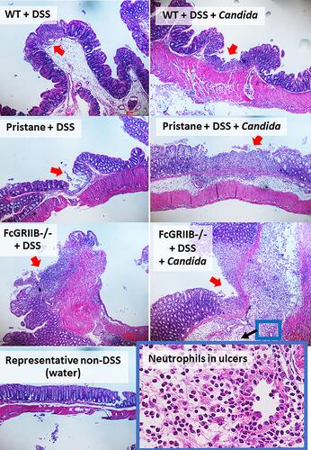 Figure 4 Representative pictures of hematoxylin and eosin (H&E) stained sections from colons of mice from wild-type (WT), Pristane and FcGRIIB-/- groups after the administration of dextran sulfate solution (DSS) alone or with Candida gavage (DSS+Candida) and FcGRIIB-/- with water control (water) (original magnification 200x) are demonstrated. A high magnification (400x) picture at the ulcer-base in FcGRIIB-/- mice with DSS + Candida (the inset picture with blue outline) indicates neutrophil infiltration in the colon ulcer. Colon pictures of mice with control water from WT and Pristane group are not presented due to the similarity to FcGRIIB-/- with water control. Red arrows indicate ulcer lesions.