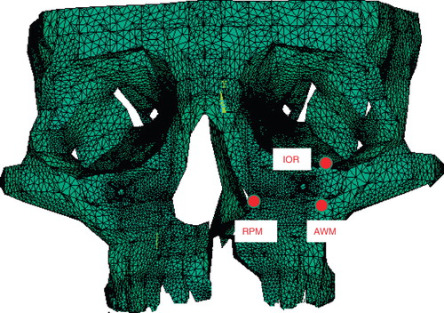 Figure 6.  Sites of the three marking points at which deviation was evaluated. IOR=inferior orbital rim; RPM=rim of the pyriform margin; and AWM=anterior wall of the maxilla.