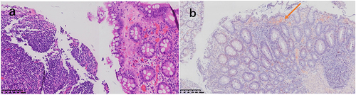 Figure 4 (a and b) Chronic inflammation of the transverse colonic mucosa with lymphocytosis (HE staining, ×100), amyloid deposits are visible in the mucosal layer of the transverse colon through Congo red staining (arrowed).