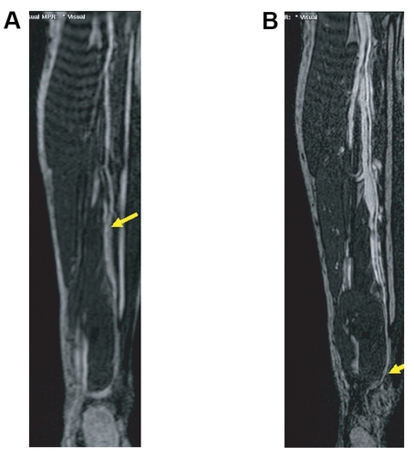 Figure 3 Sixty-four-year-old male presented with known peripheral vascular disease. The MRA suggests an occlusion of the fibular artery at the level of the distal calf on the first-pass image: the vessel cannot be identified even on the curved MPR (A) due to venous overlay (A). However, curved MPR of the higher spatial resolution steady-state images (B allows for clear identification of the distal fibular artery next to the fibular vein and allows for depiction of the distal collateral filling of the posterior tibial artery. Image courtesy Winfried Willinek, Department of Radiology, University of Bonn/Germany).