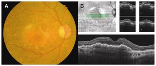 Figure 4 After 3 monthly intravitreal injection of ranibizumab. Fine wrinkles are more evident and some fibrotic changes are noted along the superotemporal and superonasal border of the lesion (A). An optical coherence tomographic finding did not change significantly compared to the previous image (B).