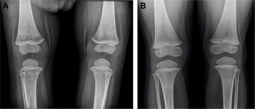 Figure 4 Plain radiograph of the knees (A) before and (B) after vemurafenib treatment.