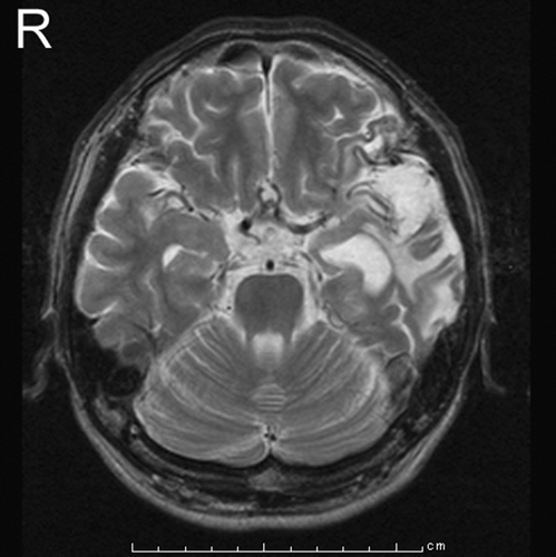 Figure 1. A magnetic resonance imaging (MRI) scan taken 5 years after the accident showing high-intensity areas in the left temporal and frontal lobes as well as micro-hemorrhaging in the right midbrain, temporal lobe, and frontal lobe.