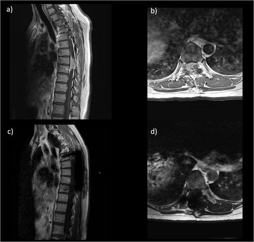 Figure 3. Case of benign thoracic spine tumour with pre-operative contrast MRI images showing the recurrent thoracic meningioma in sagittal (a) and axial (b) views. Post-operative images show satisfactory resection in sagittal (c) and axial (d) views.